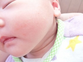 アレルギーを持つ赤ちゃん